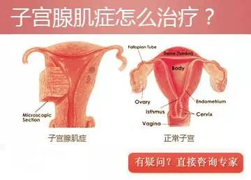 子宫腺肌症最新治疗方法,子宫腺肌症最新治疗方法，照亮女性健康的希望之光，子宫腺肌症最新治疗方法，为女性健康带来希望之光